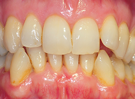 Before Treatment